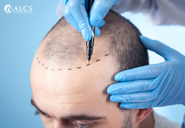 Hair Loss Treatment
