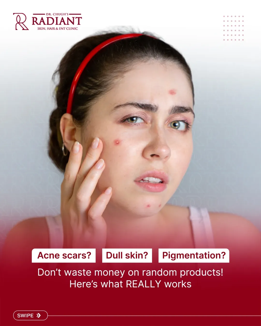 Patient concerned about acne and skin texture