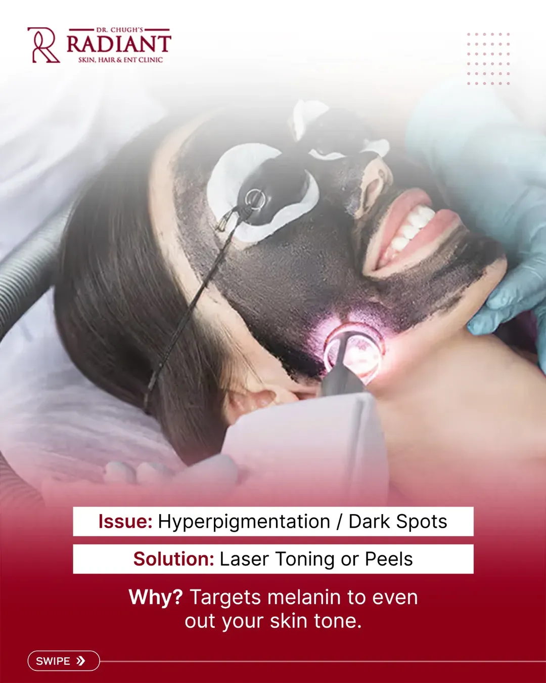 Laser skin treatment for pigmentation