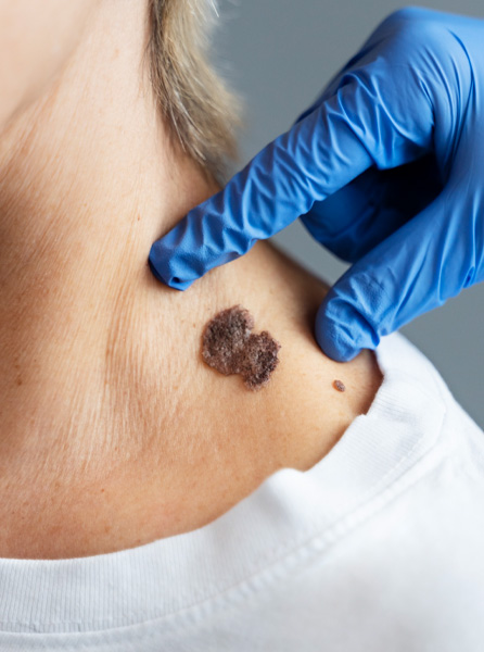 Skin Tags, Wart & Mole Removal