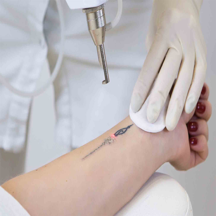 Tattoo Removal Treatment